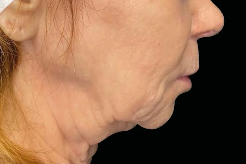 EMface facial toning Dublin - before photo of the neck in profile Neck in profile before EMface facial toning at our Dublin clinic